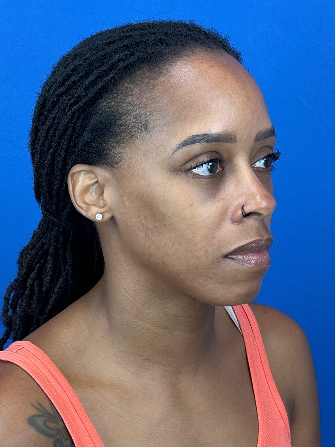 Lower Blepharoplasty Before & After