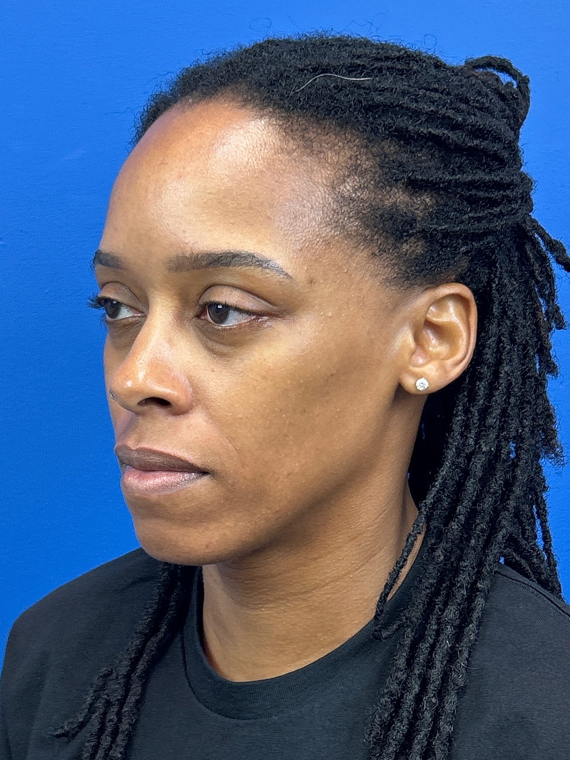 Lower Blepharoplasty Before & After