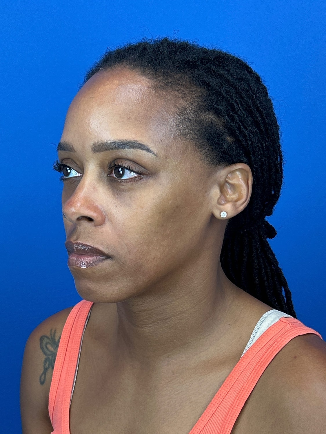 Lower Blepharoplasty Before & After