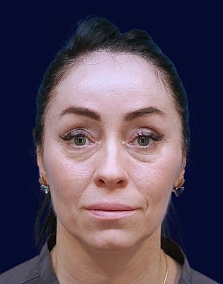Lower Blepharoplasty Before & After
