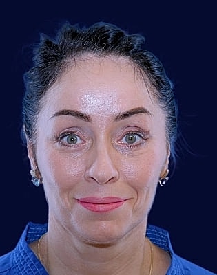 Lower Blepharoplasty Before & After