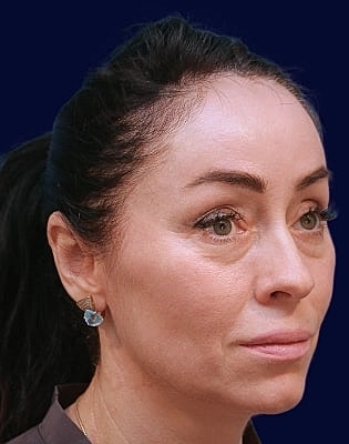 Lower Blepharoplasty Before & After