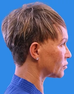 Lower Blepharoplasty Before & After