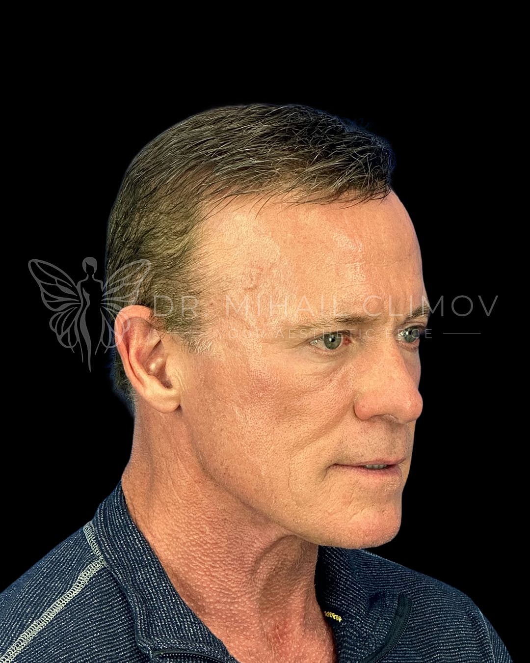 Male lower blepharoplasty after photo, left oblique view, showing eliminated under-eye puffiness and restored contour following eyelid surgery in Houston, Texas.