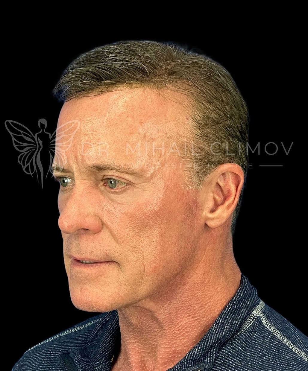 Male lower eyelid blepharoplasty after photo, right oblique view, showing refreshed and well-rested appearance after cosmetic eyelid surgery in Houston.