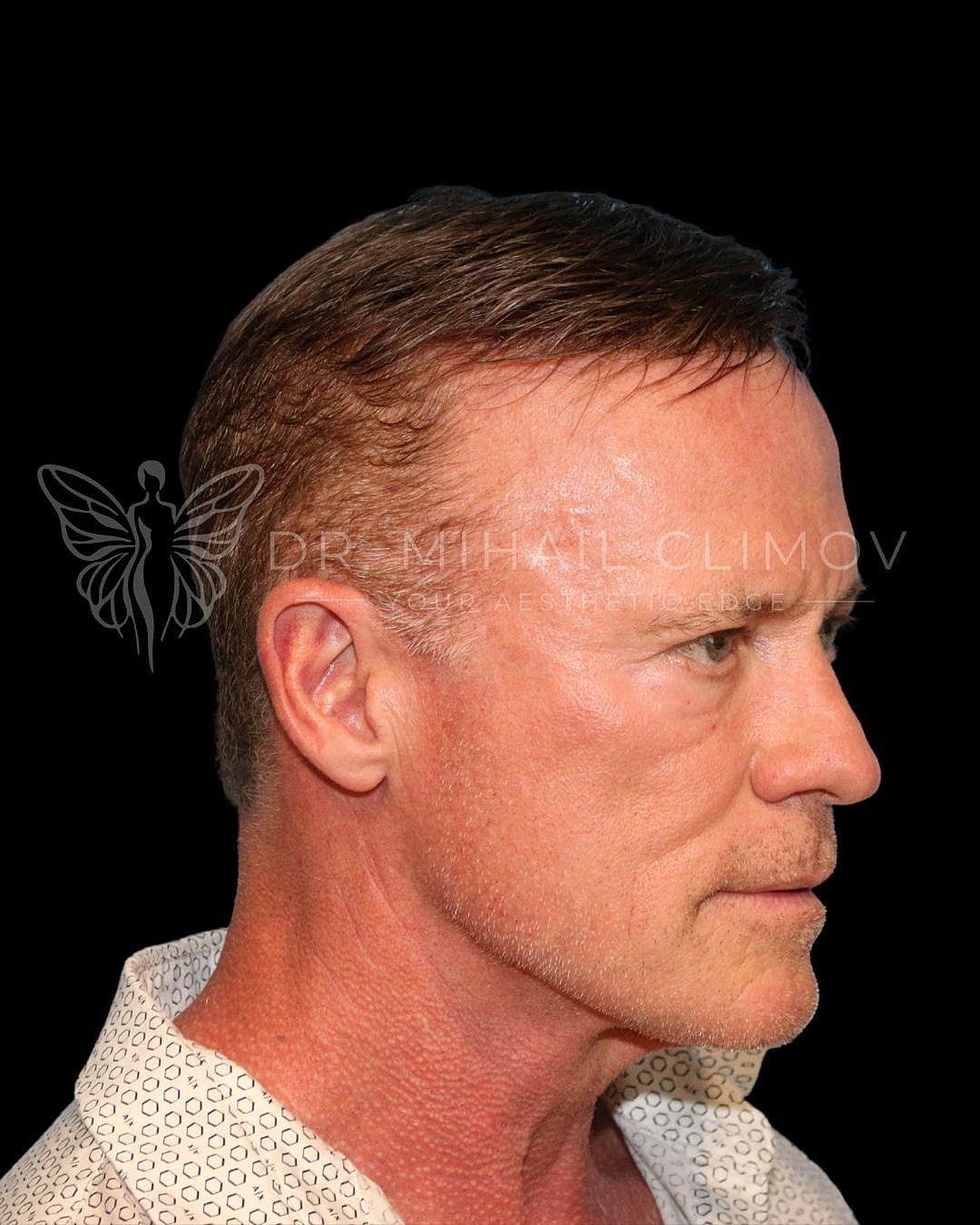 Male lower blepharoplasty before photo, left oblique view, showing puffy lower lids and dark hollowing prior to eyelid surgery in Houston, TX.
