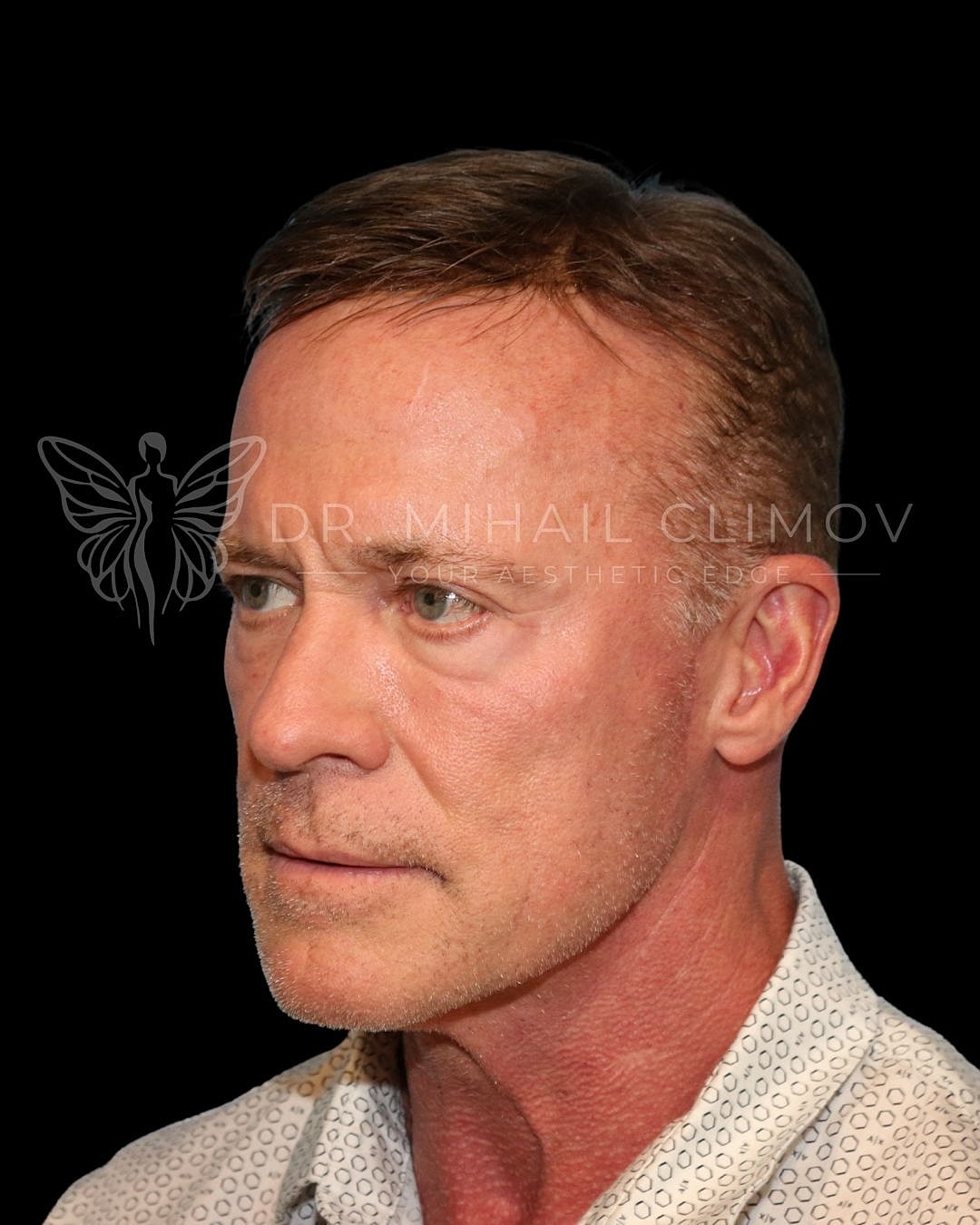 Male lower eyelid blepharoplasty before photo, right oblique view, showing under-eye bags and tired appearance prior to cosmetic eyelid surgery in Houston.