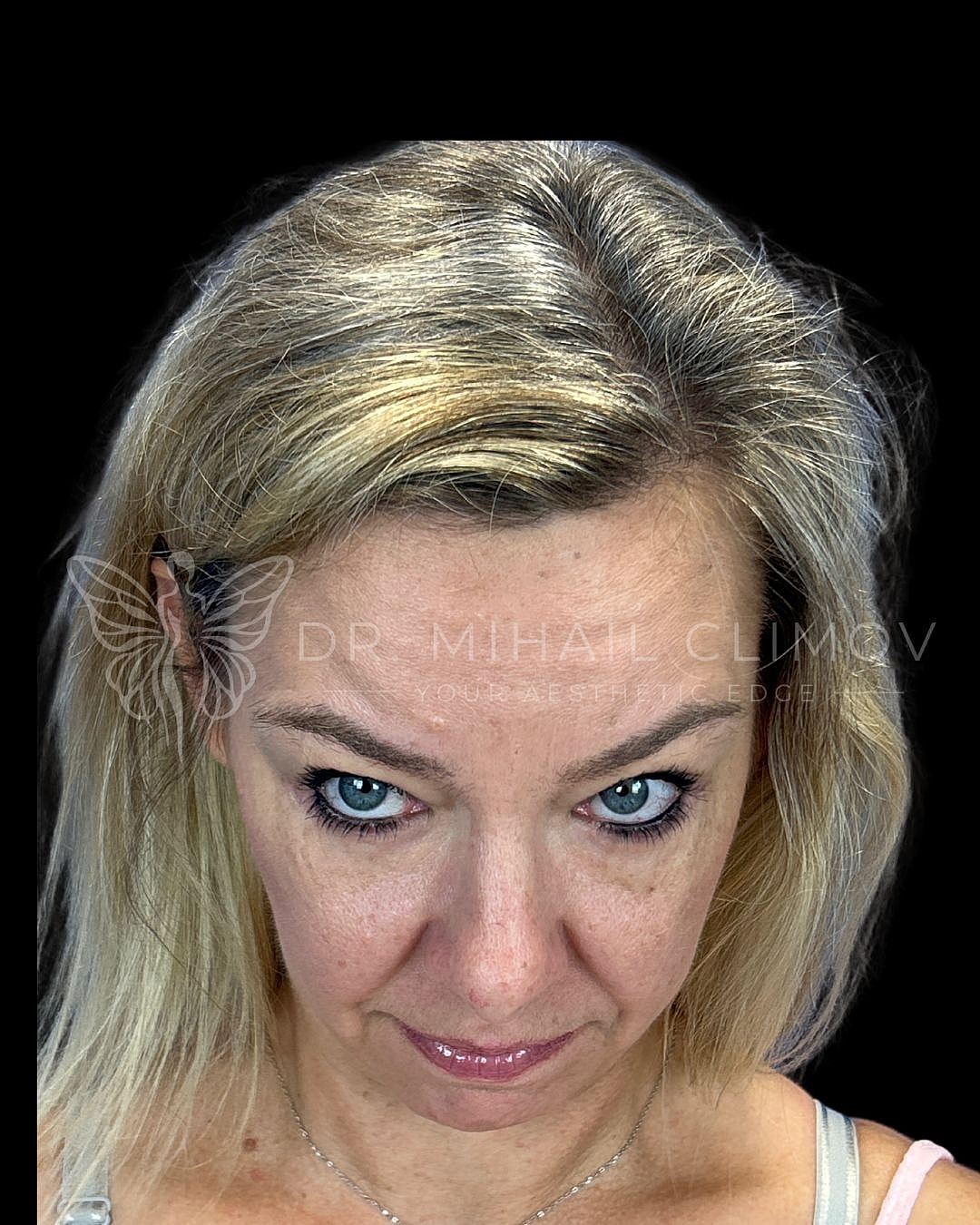 .Female lower eyelid blepharoplasty after photo, front chin-down view, showing eliminated eye bags and restored lower lid contour following cosmetic eyelid surgery in Houston.