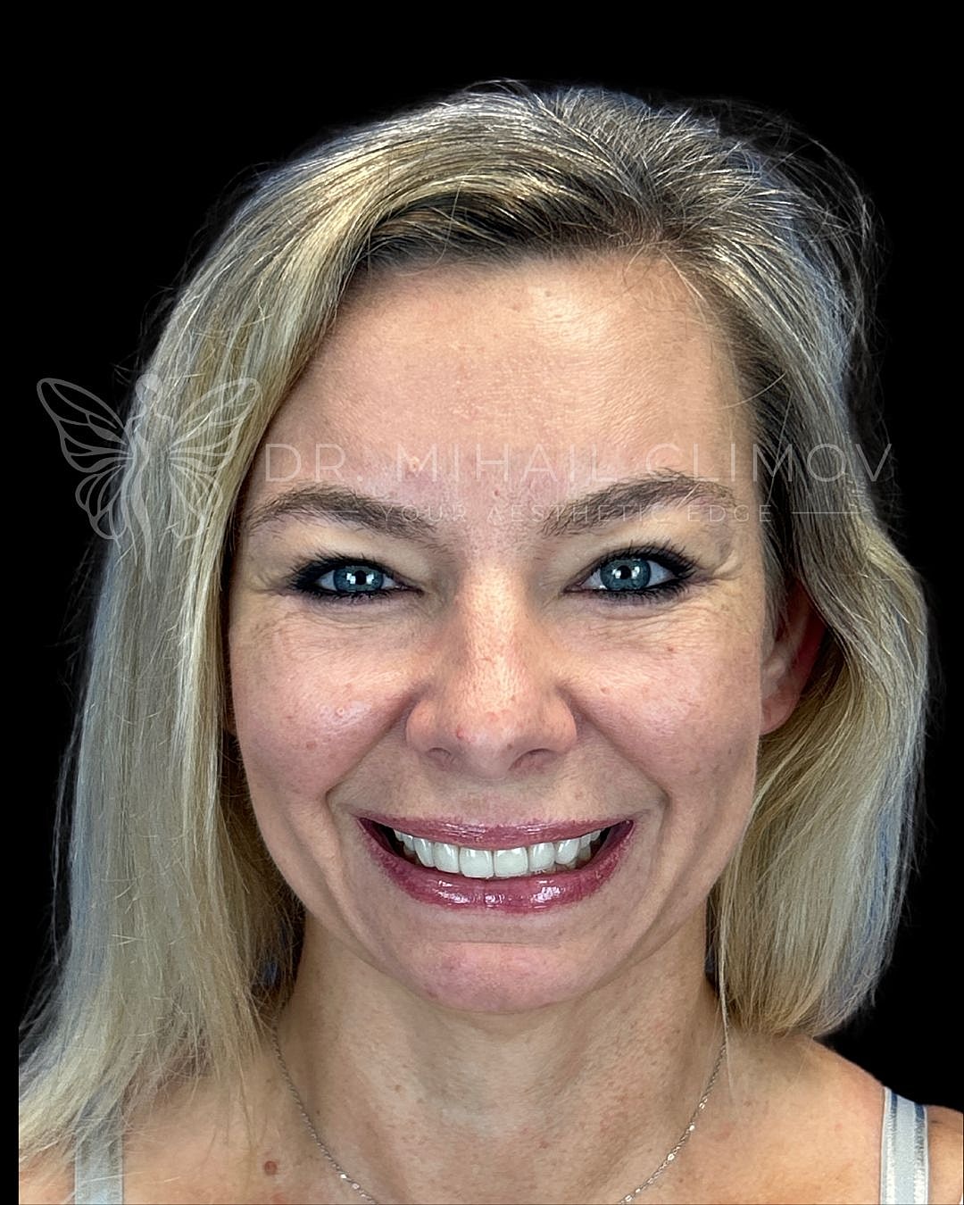 Female lower blepharoplasty after photo, front smiling view, showing natural under-eye results and bright expression following lower eyelid surgery in Houston, TX.