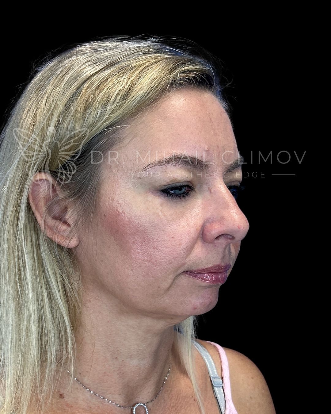 Female lower blepharoplasty after photo, left oblique view, showing youthful under-eye profile and rejuvenated appearance following lower eyelid surgery in Houston, Texas.