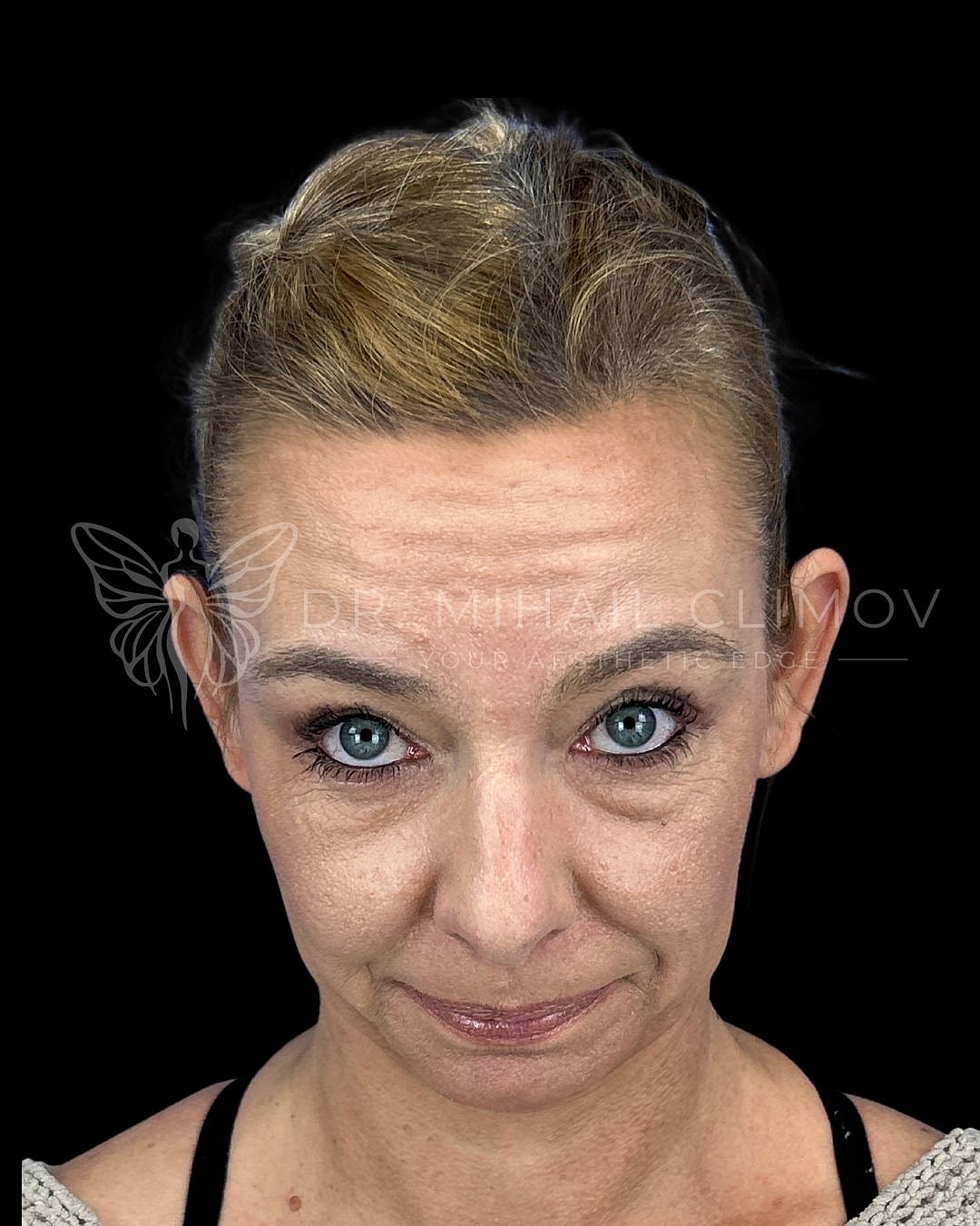 Female lower eyelid blepharoplasty before photo, front chin-down view, showing prominent eye bags and lower lid fat herniation prior to cosmetic eyelid surgery in Houston.