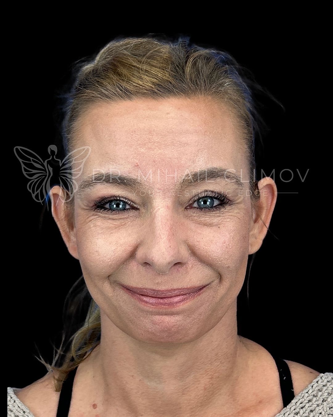 Female lower blepharoplasty before photo, front smiling view, showing under-eye puffiness and skin crepiness prior to lower eyelid surgery in Houston, TX.