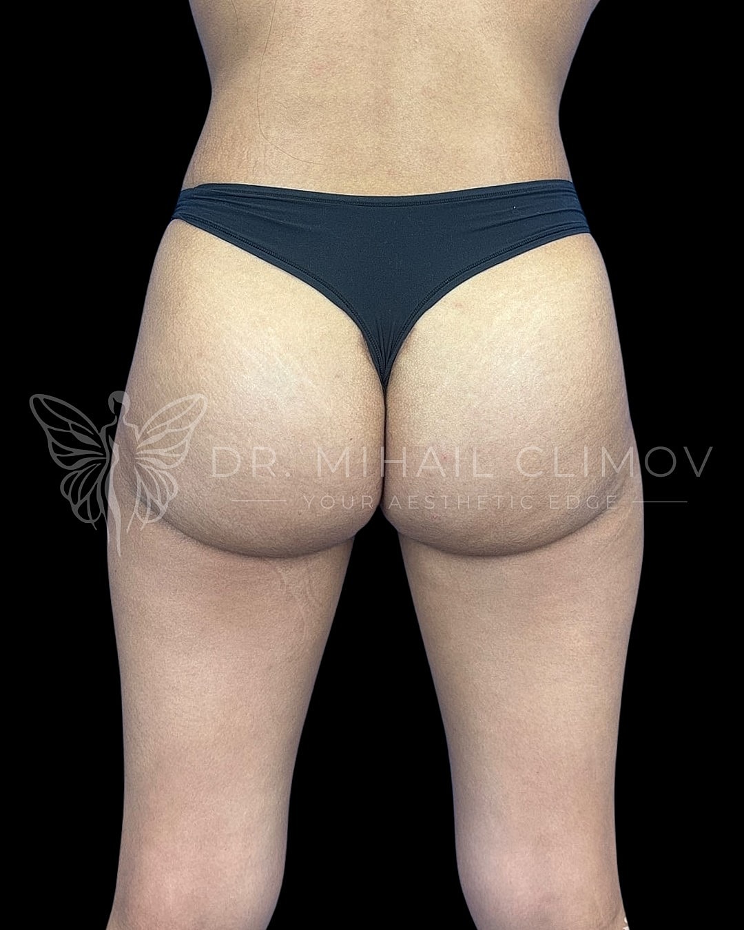 _after_front.png After BBL (Brazilian butt lift) results – front view – Dr. Mihail Climov, Aesthetic Plastic Surgeon, Houston, TX