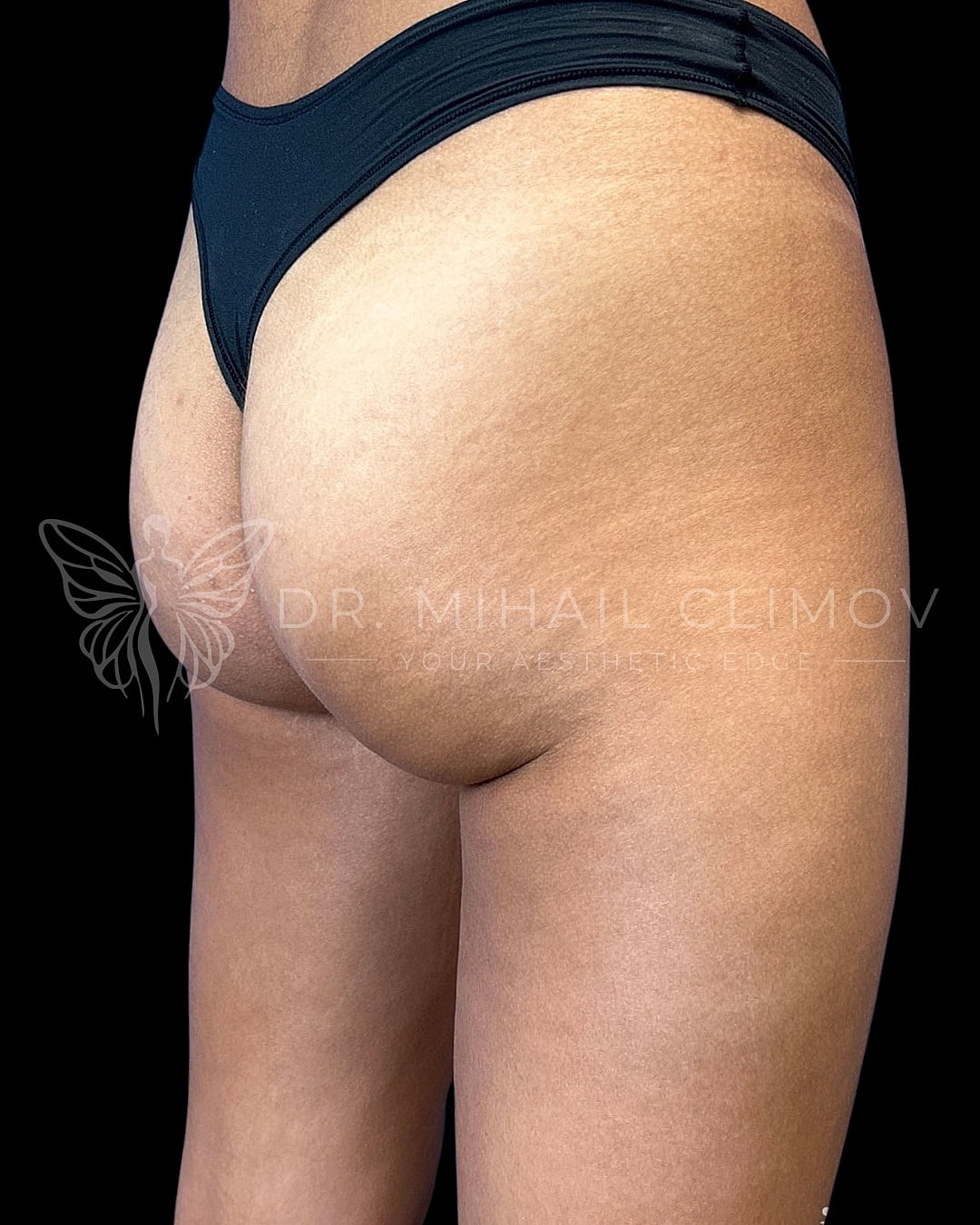 _before_right_3_4.png Before BBL (Brazilian butt lift) surgery – right 3/4 angle view – Dr. Mihail Climov, Aesthetic Plastic Surgeon, Houston, TX