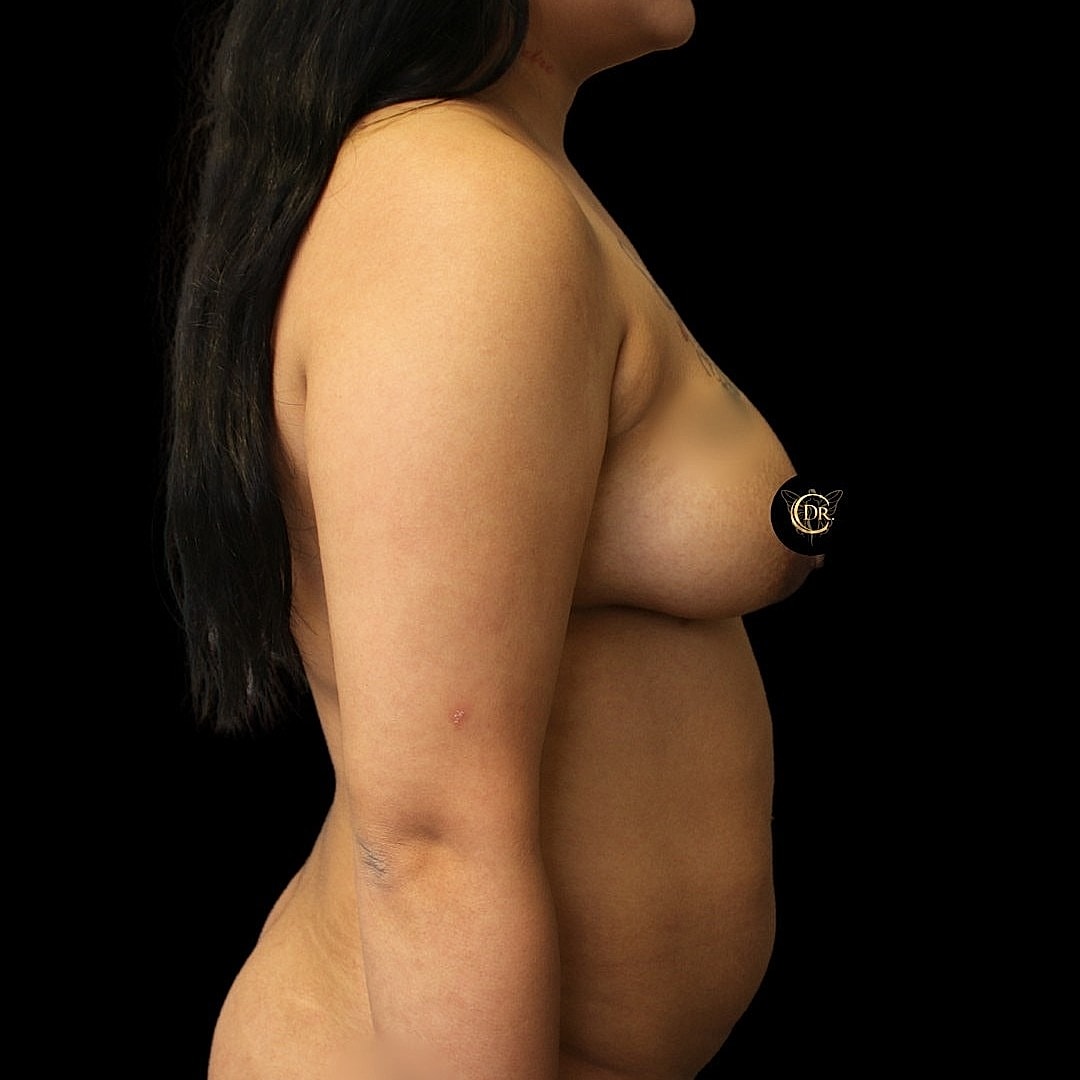 Breast lift before and after Houston