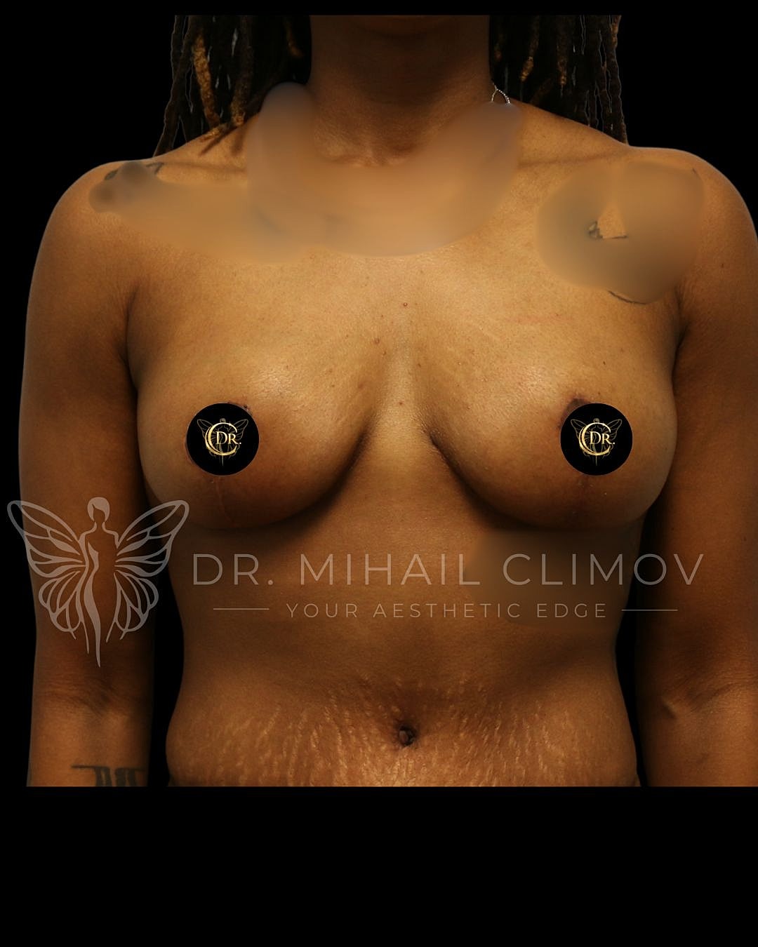 Breast Lift Before & After