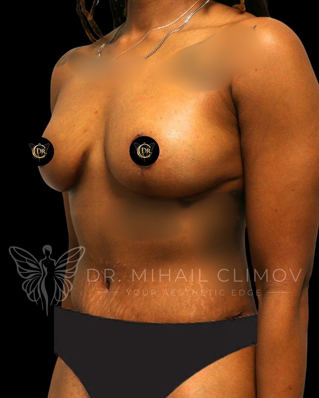 Breast Lift Before & After
