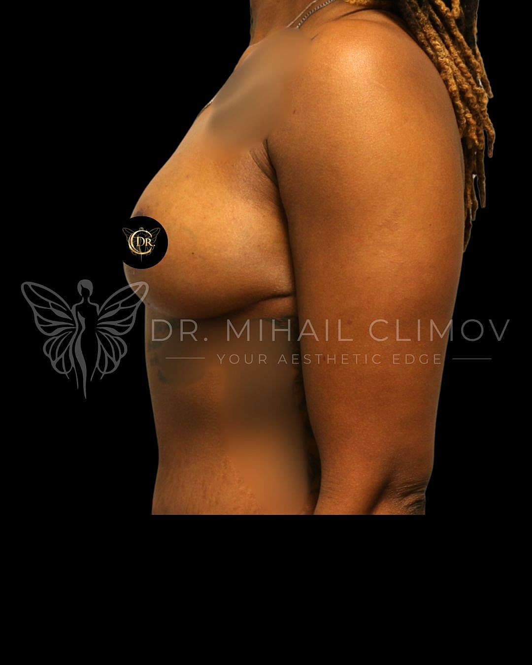 Breast Lift Before & After