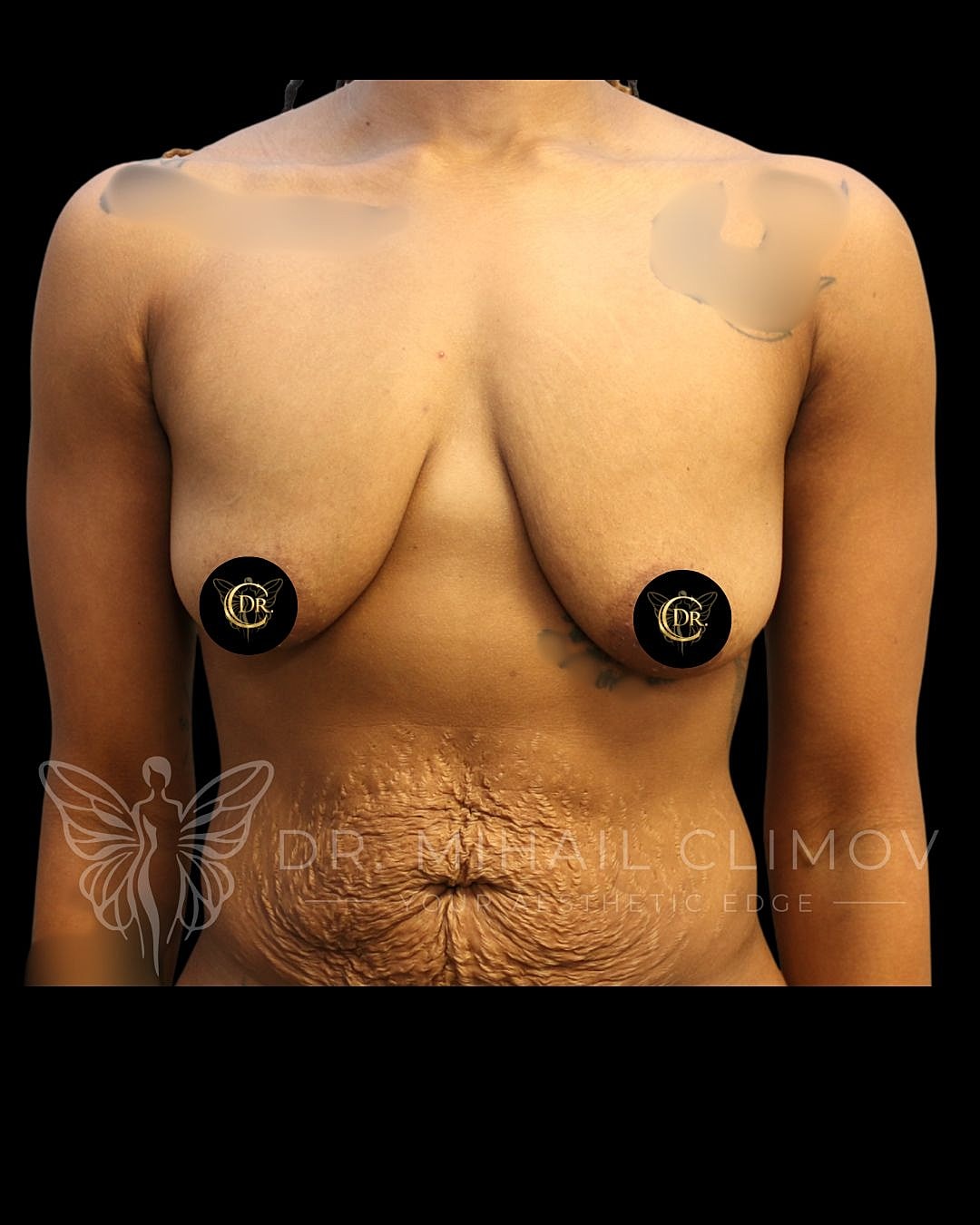 Breast Lift Before & After