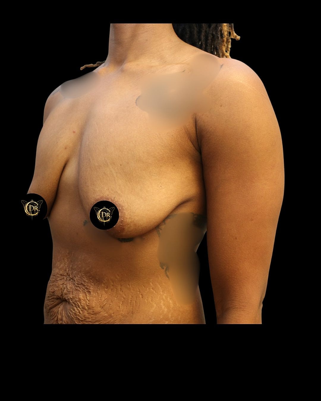 Breast Lift Before & After