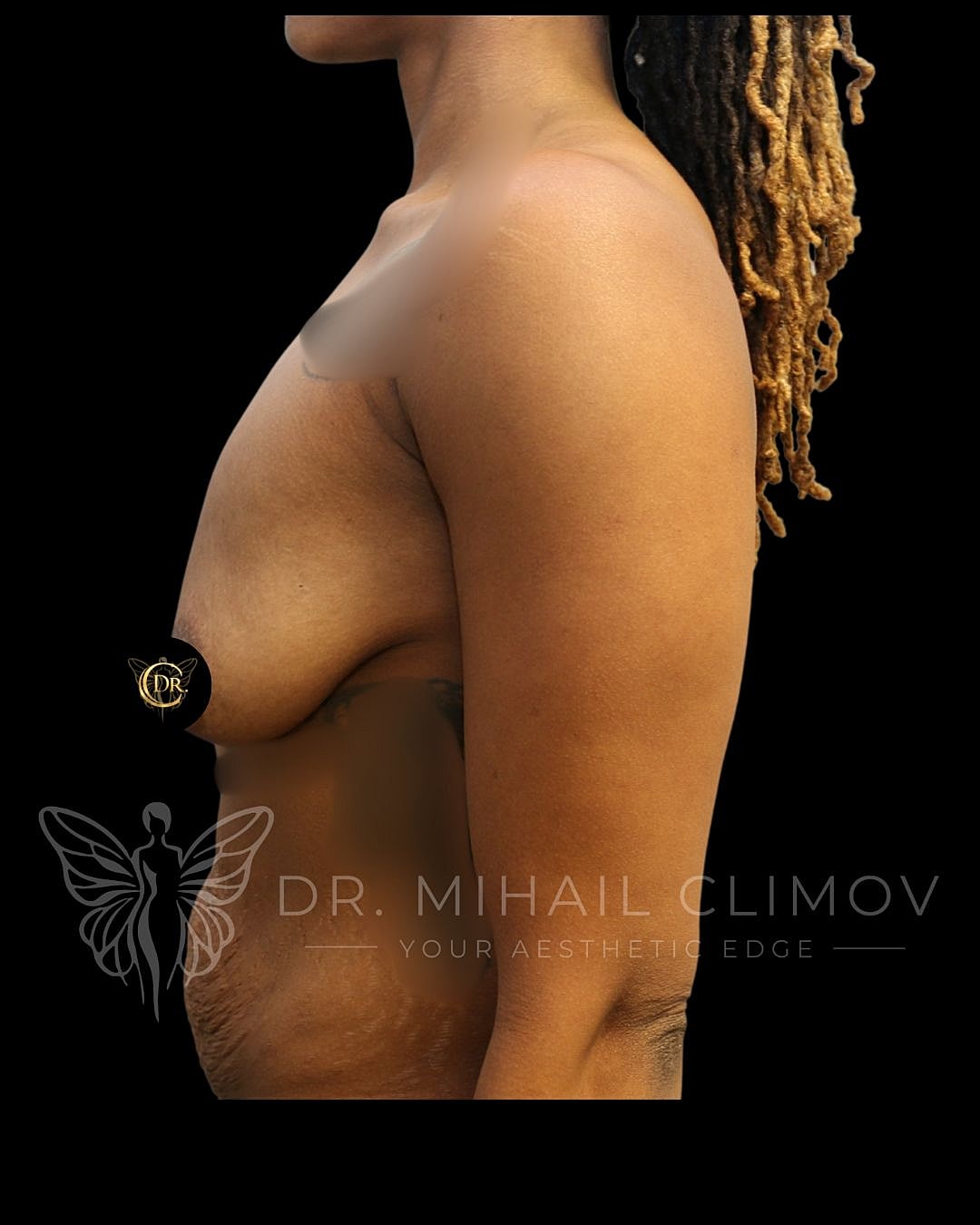 Breast Lift Before & After