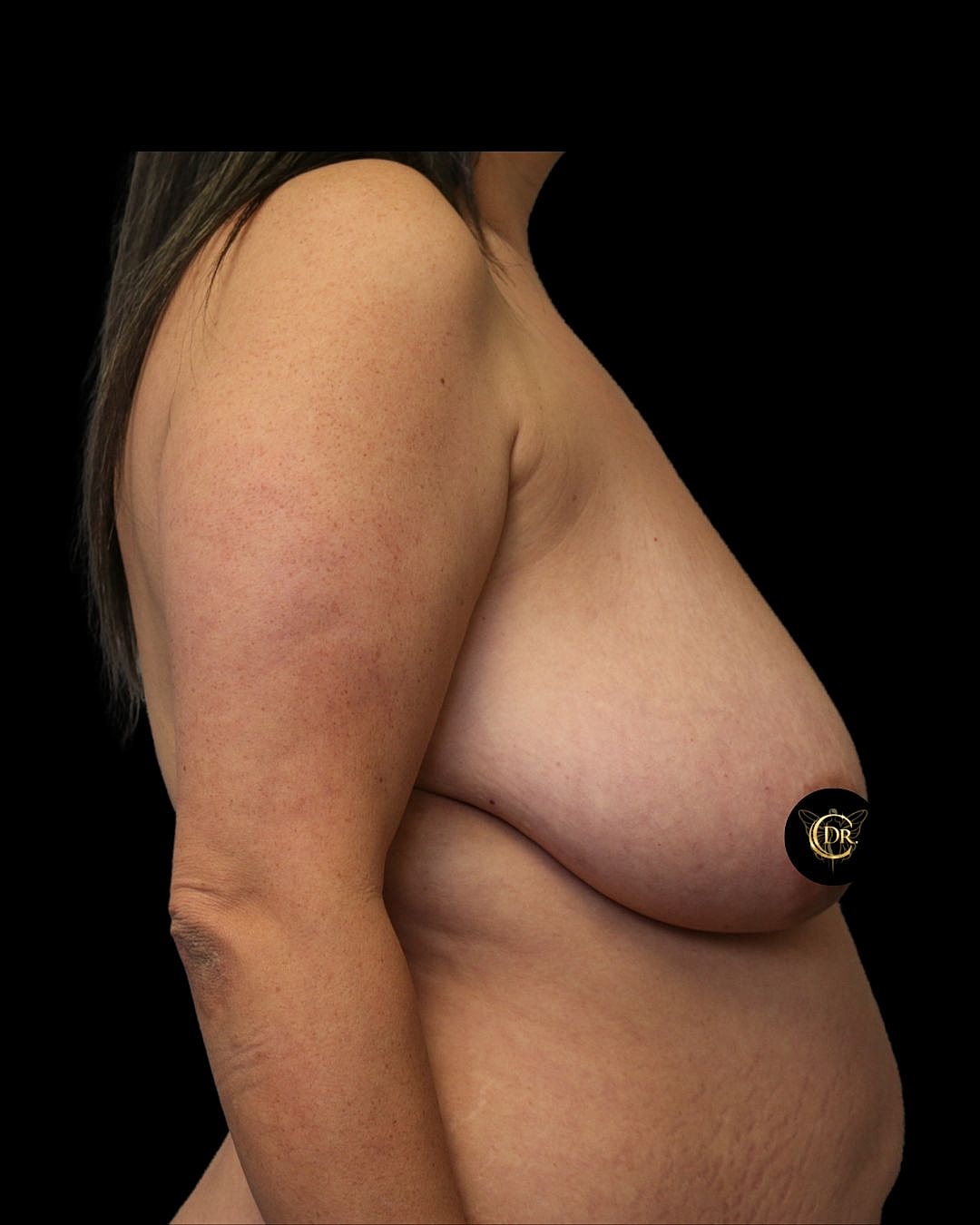Breast Lift Before & After