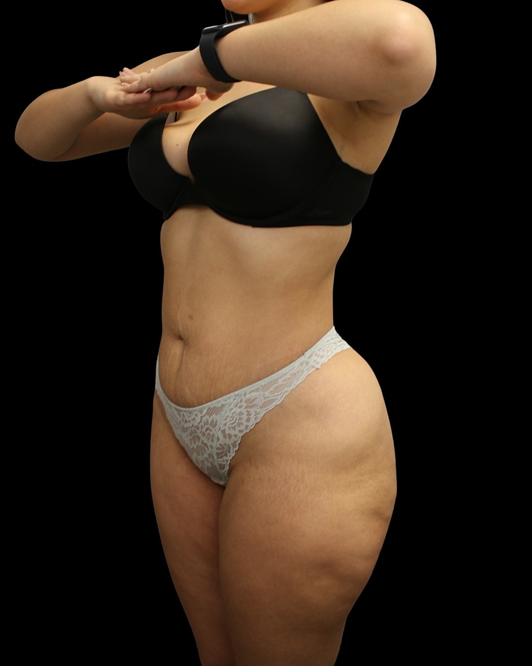 Liposuction Before & After