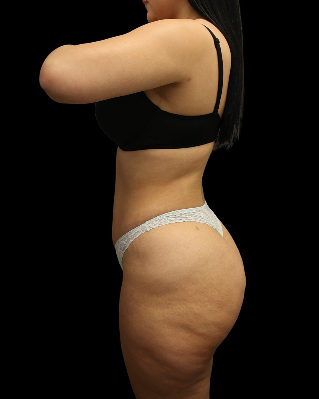 Liposuction Before & After