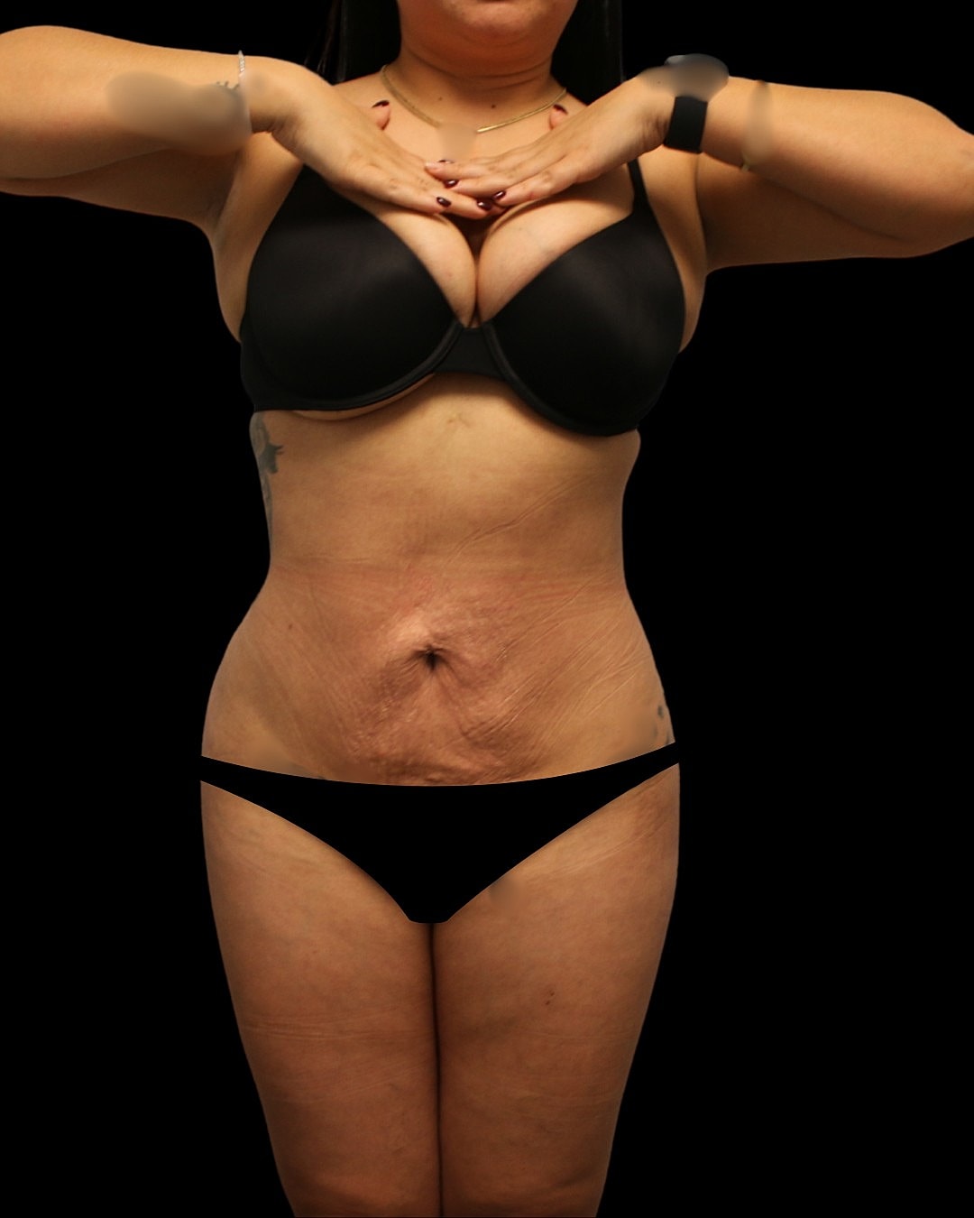 Dr. Mihail Climov 360 liposuction results