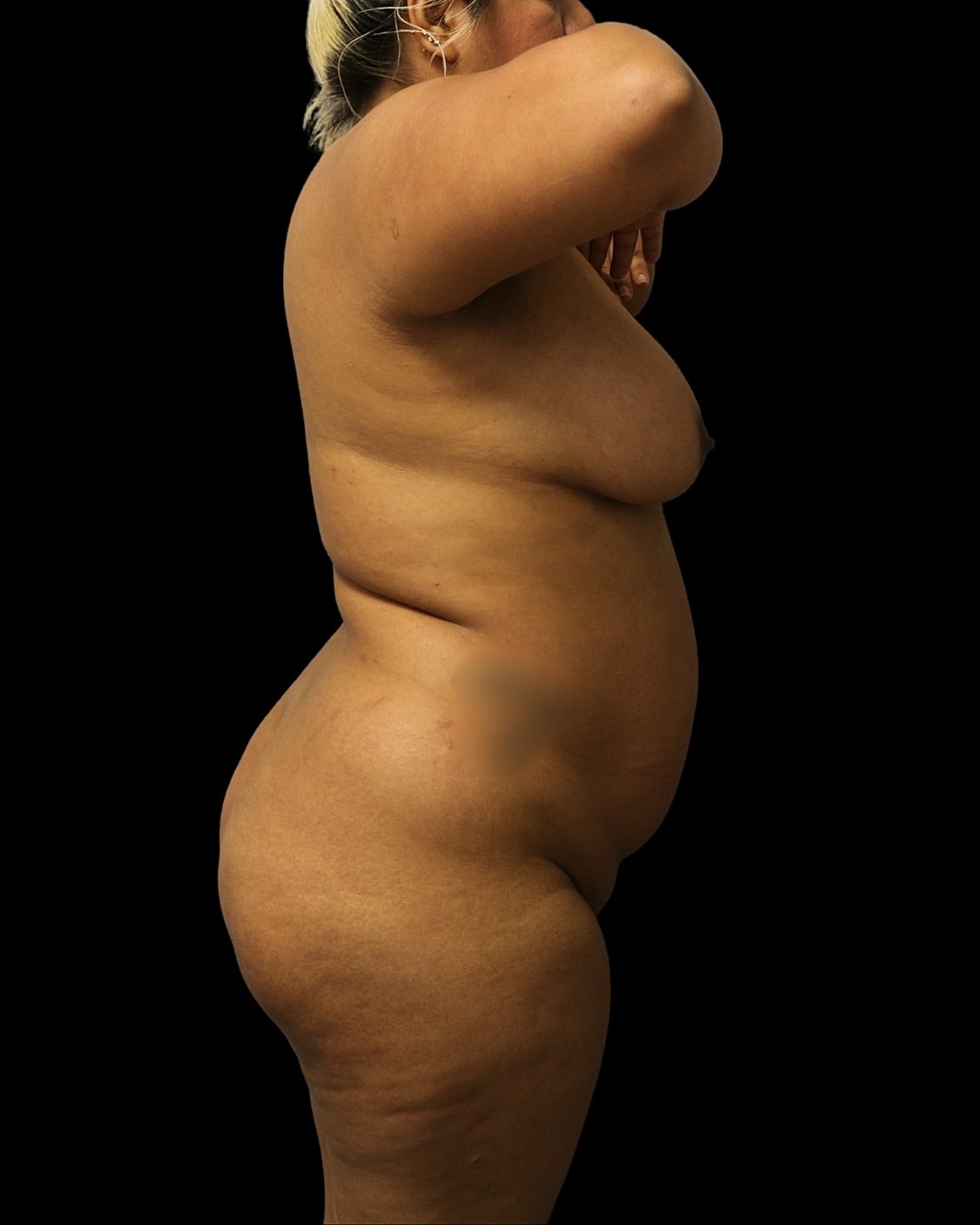 Liposuction Before & After