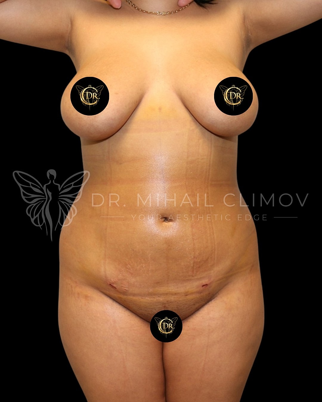 Case_001_after_front.png After HD liposuction results – front view – Dr. Mihail Climov, Aesthetic Plastic Surgeon, Houston, TX