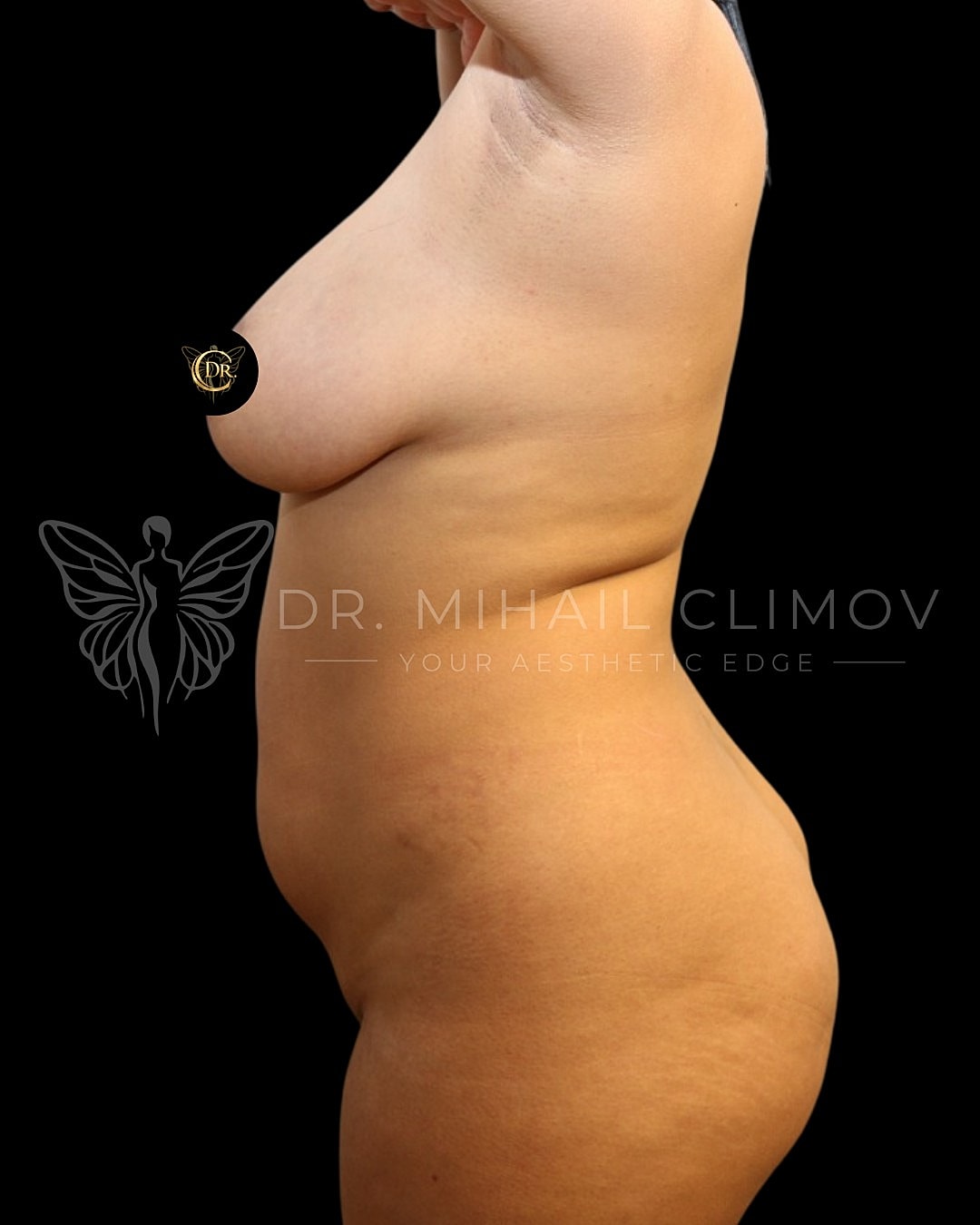 Case_001_before_left.png Before HD liposuction surgery – left side profile view – Dr. Mihail Climov, Aesthetic Plastic Surgeon, Houston, TX