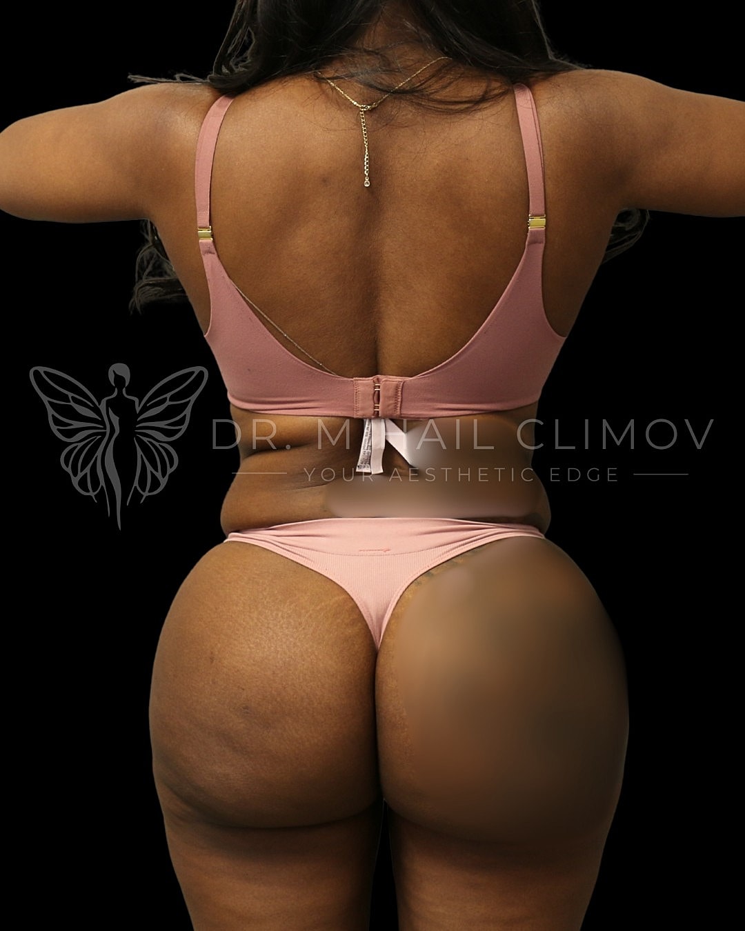 Case_014_after_back_before.png Before 360 liposuction surgery – back view – Dr. Mihail Climov, Aesthetic Plastic Surgeon, Houston, TX