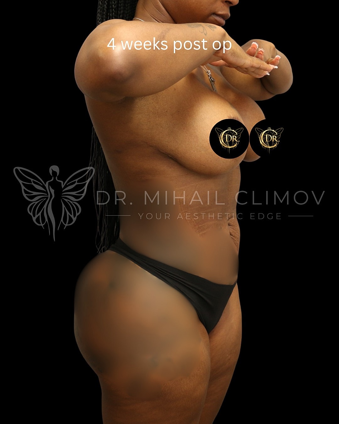 Case_014_right_after.png After 360 liposuction results at 4 weeks post-op – right side profile view – Dr. Mihail Climov, Aesthetic Plastic Surgeon, Houston, TX