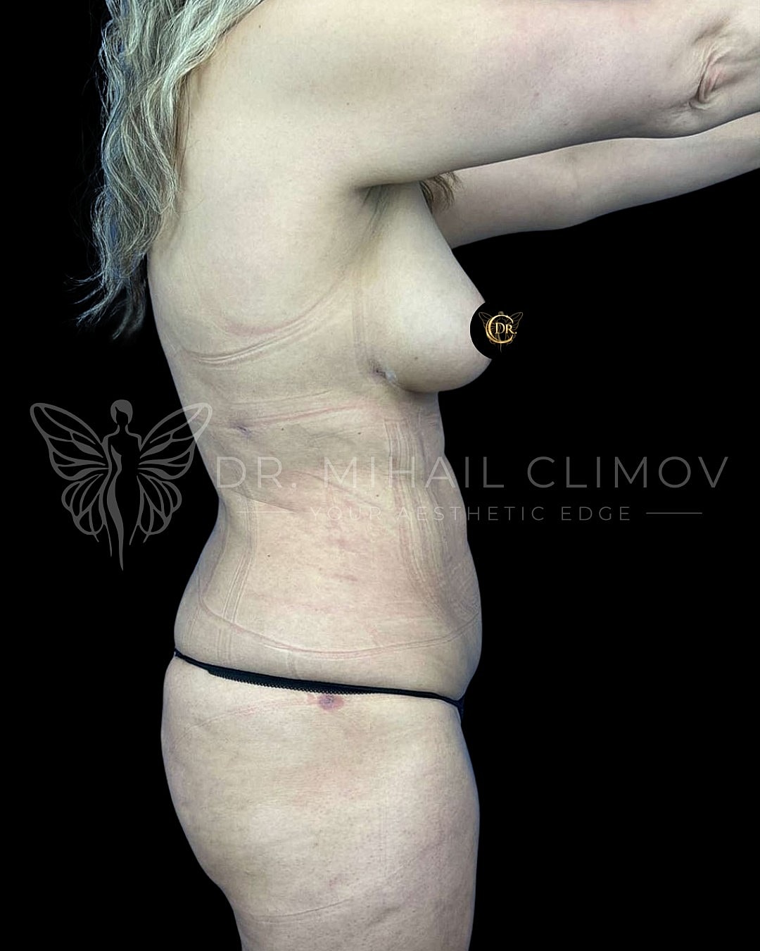 After Vaser lipo 360 results – right side profile view – Dr. Mihail Climov, Aesthetic Plastic Surgeon, Houston, TX