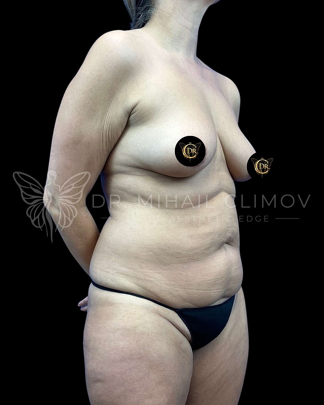 Before Vaser lipo 360 surgery – right 3/4 angle view – Dr. Mihail Climov, Aesthetic Plastic Surgeon, Houston, TX