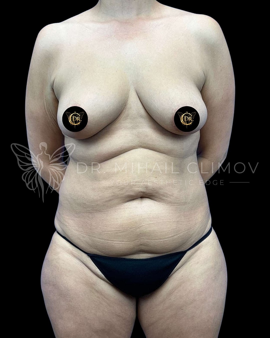 Before Vaser lipo 360 surgery – front view – Dr. Mihail Climov, Aesthetic Plastic Surgeon, Houston, TX