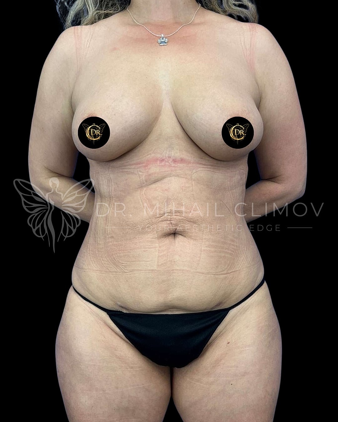 After Vaser lipo 360 results – front view – Dr. Mihail Climov, Aesthetic Plastic Surgeon, Houston, TX