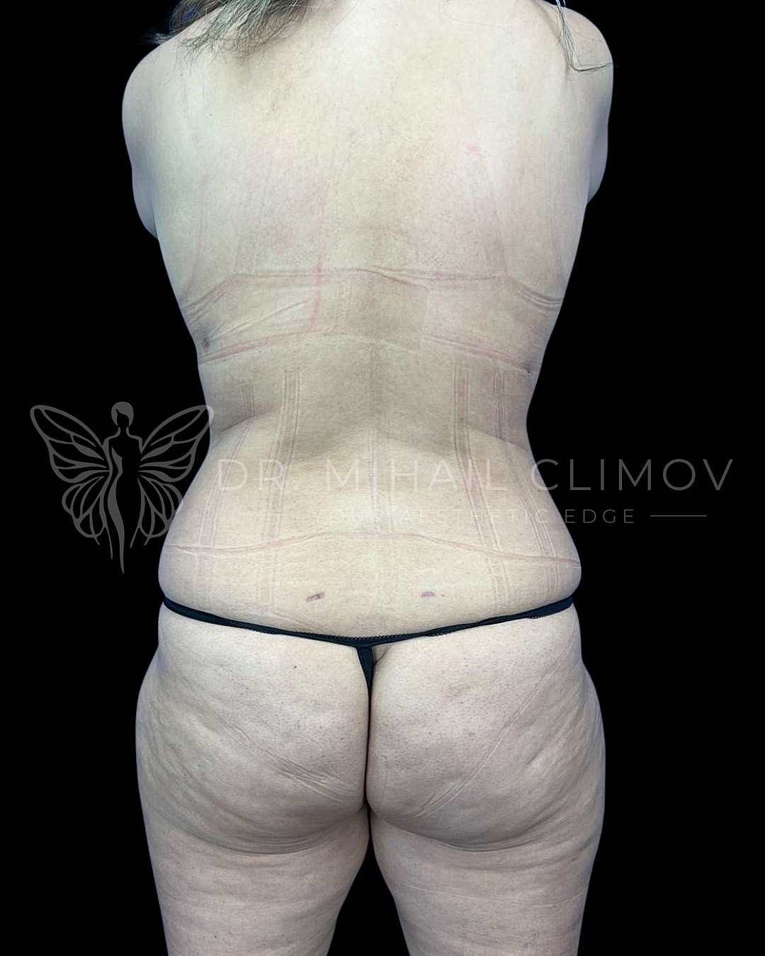 After Vaser lipo 360 results – back view – Dr. Mihail Climov, Aesthetic Plastic Surgeon, Houston, TX