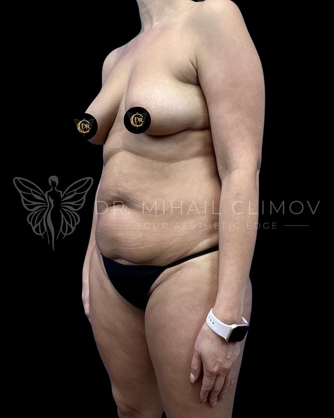 left 3/4 angle view – Dr. Mihail Climov, Aesthetic Plastic Surgeon, Houston, TX