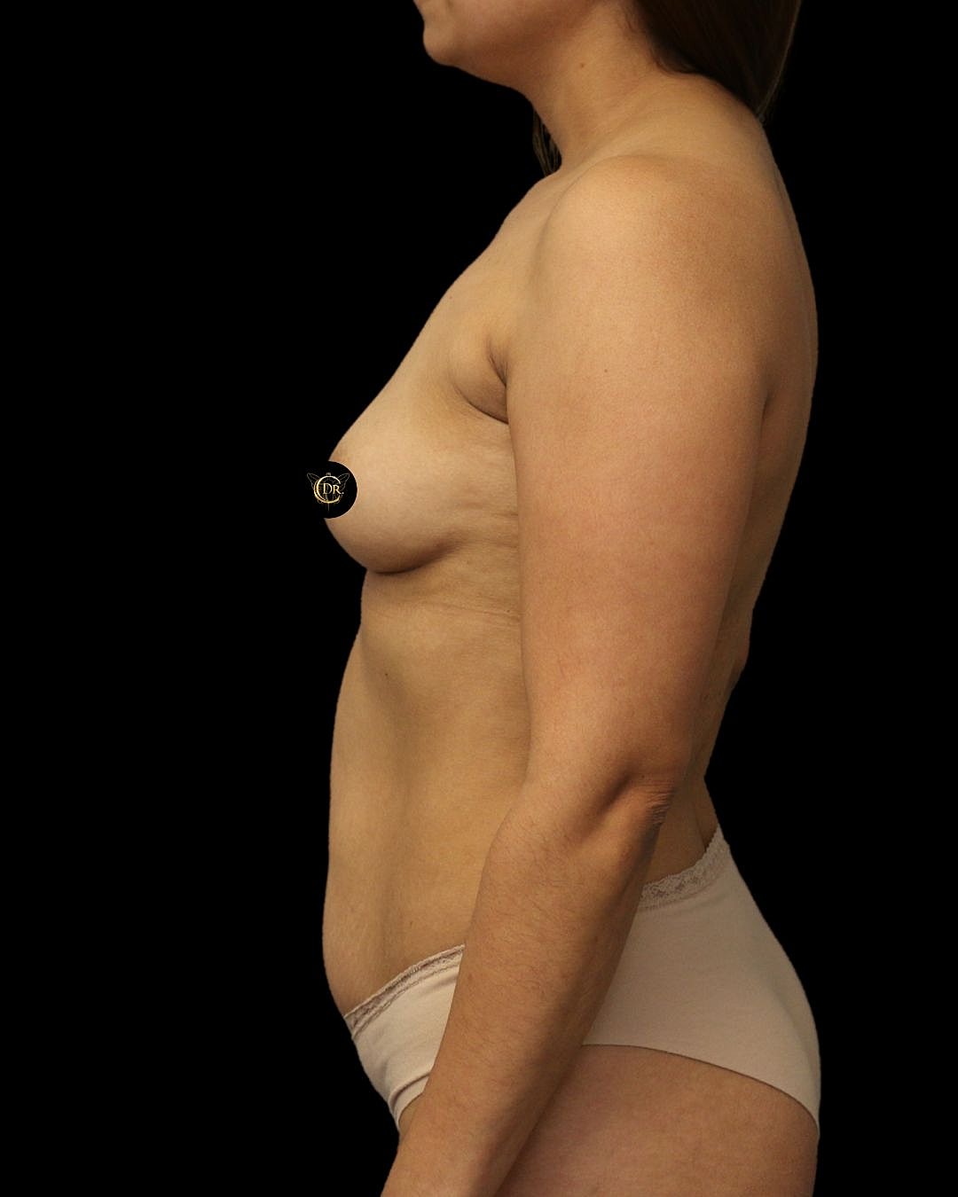 Liposuction Before & After