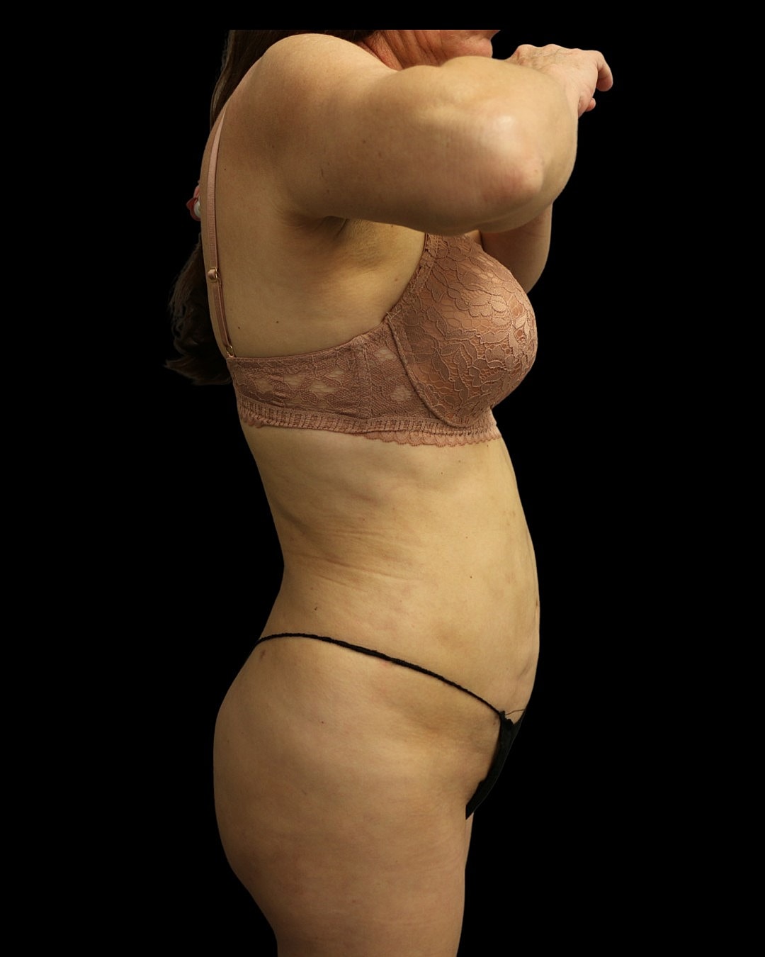 Liposuction Before & After