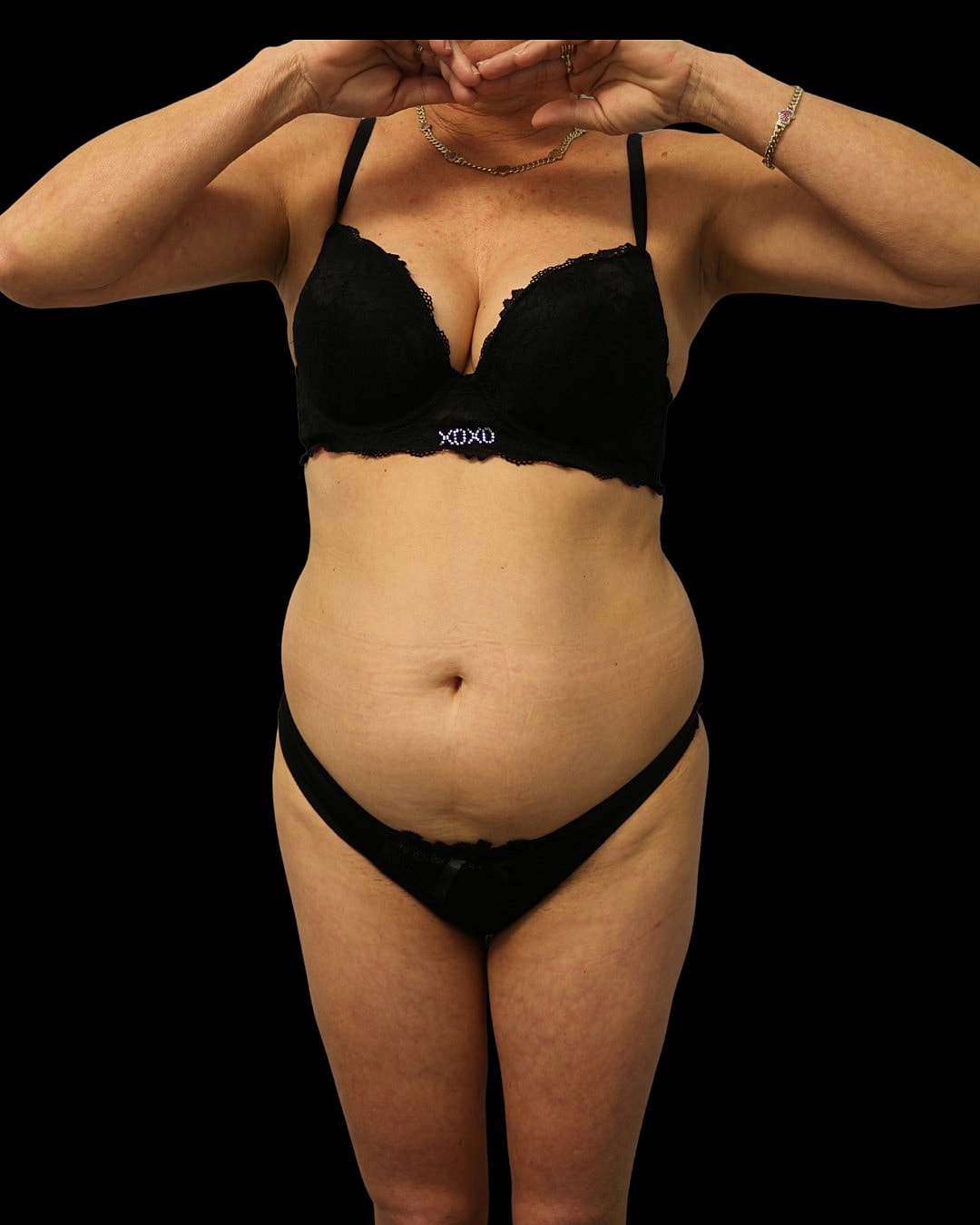 Liposuction Before & After