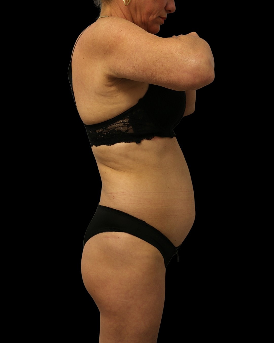 Liposuction Before & After