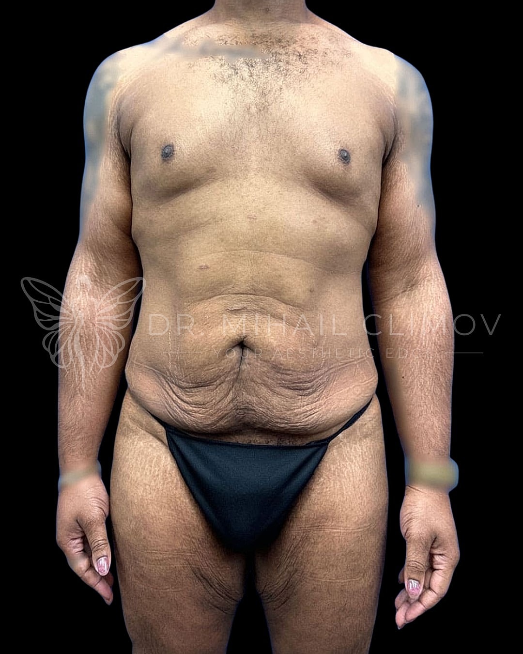 Male torso with skin texture and contour details.