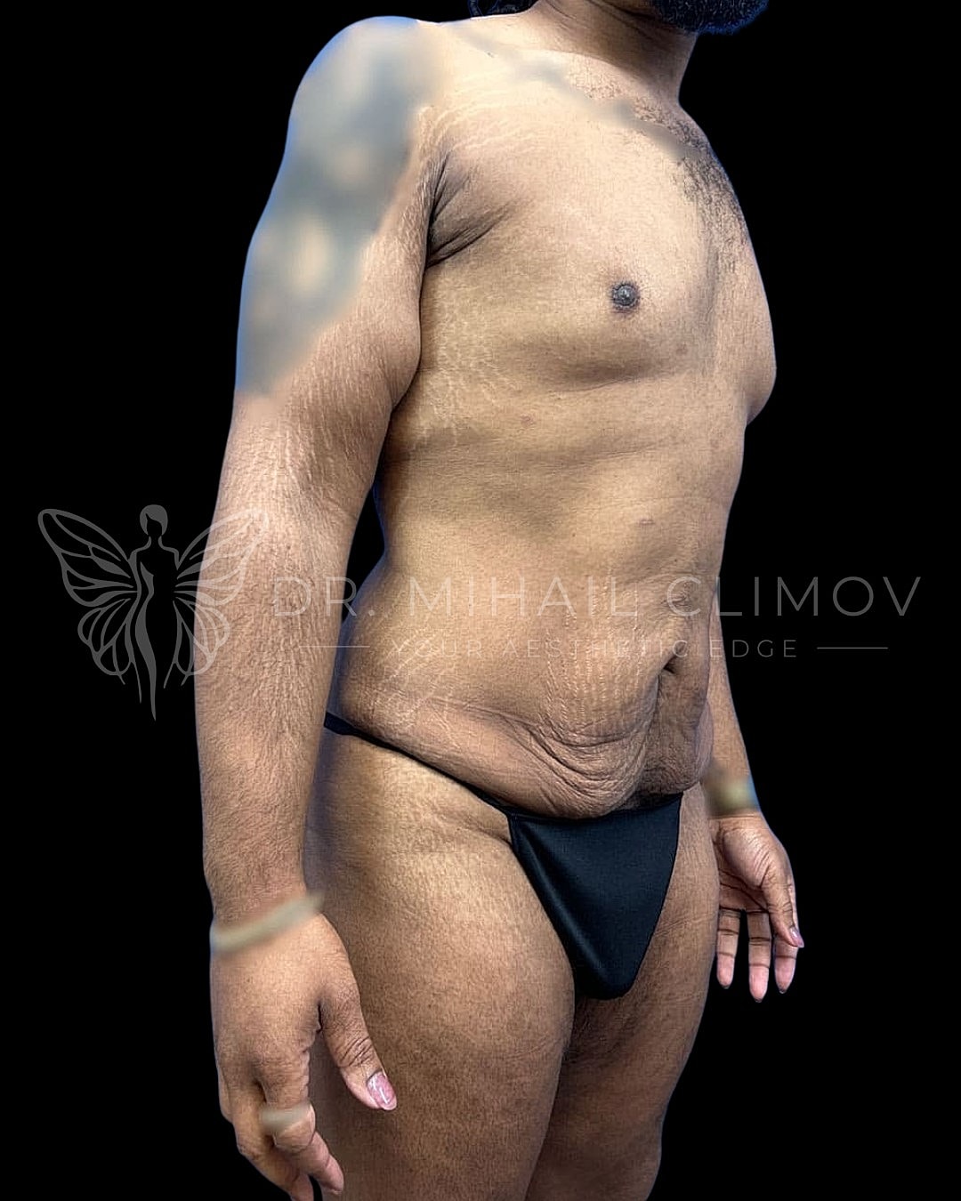 Body transformation showcasing skin texture and contours.