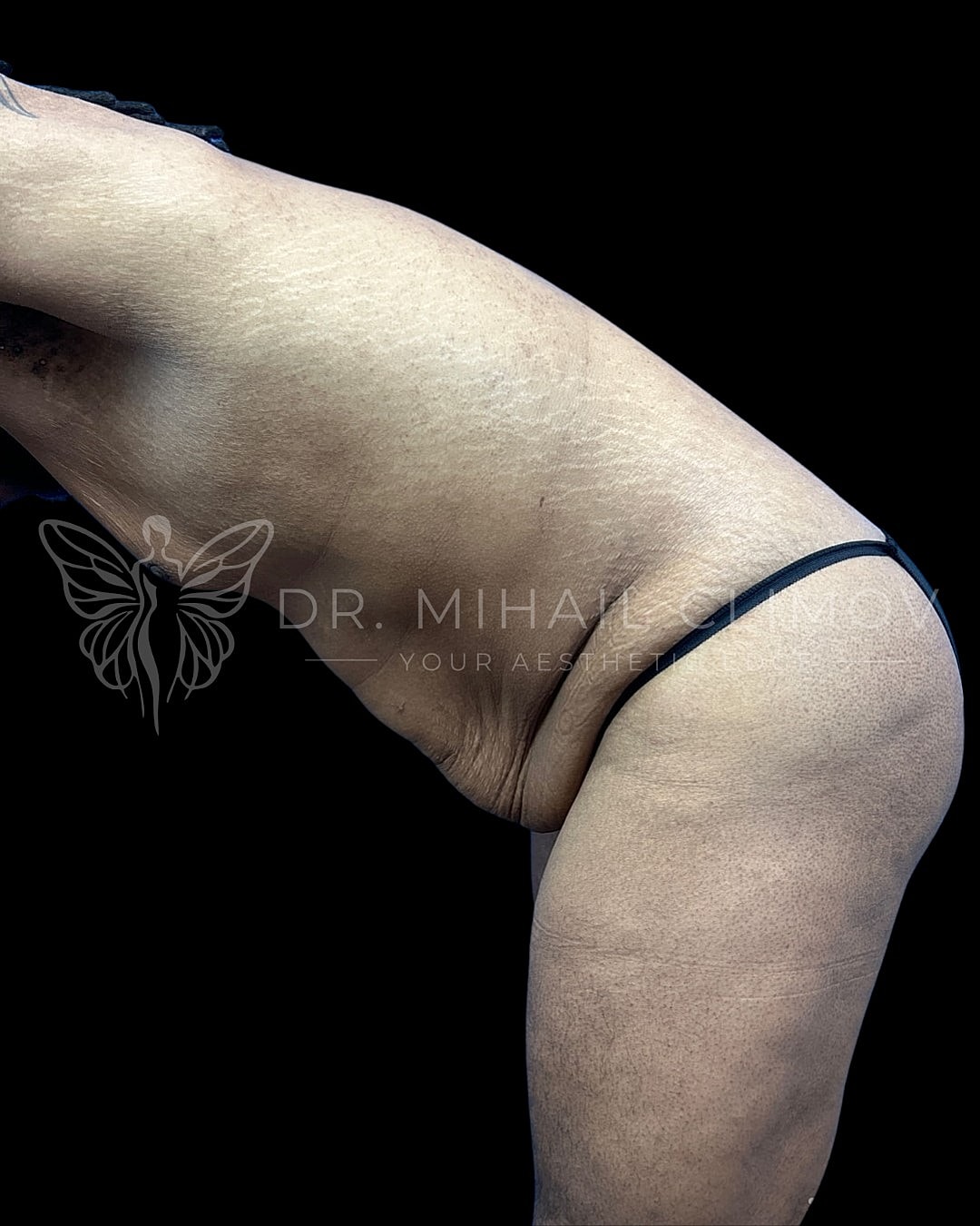 Body contouring before and after image