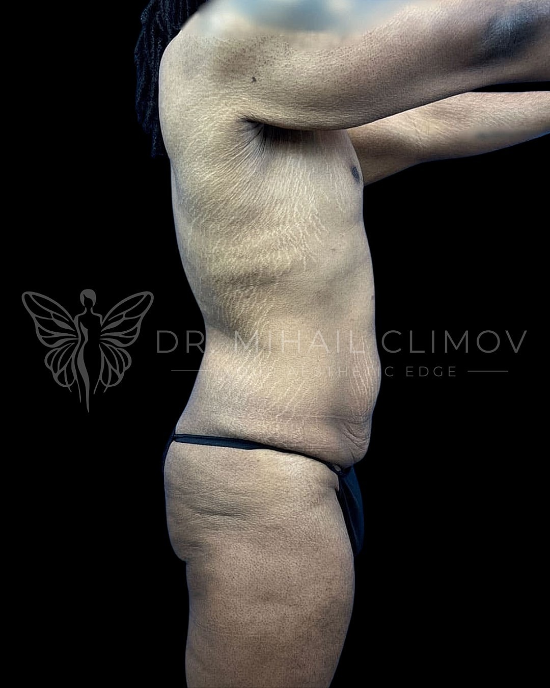 Male torso with skin texture and stretch marks.