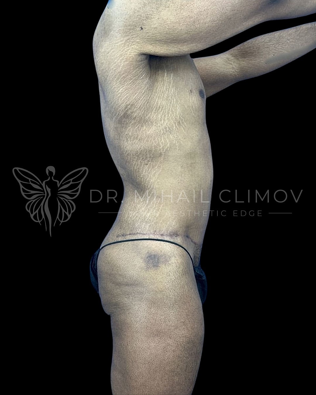 Side profile of a male torso with stretch marks.