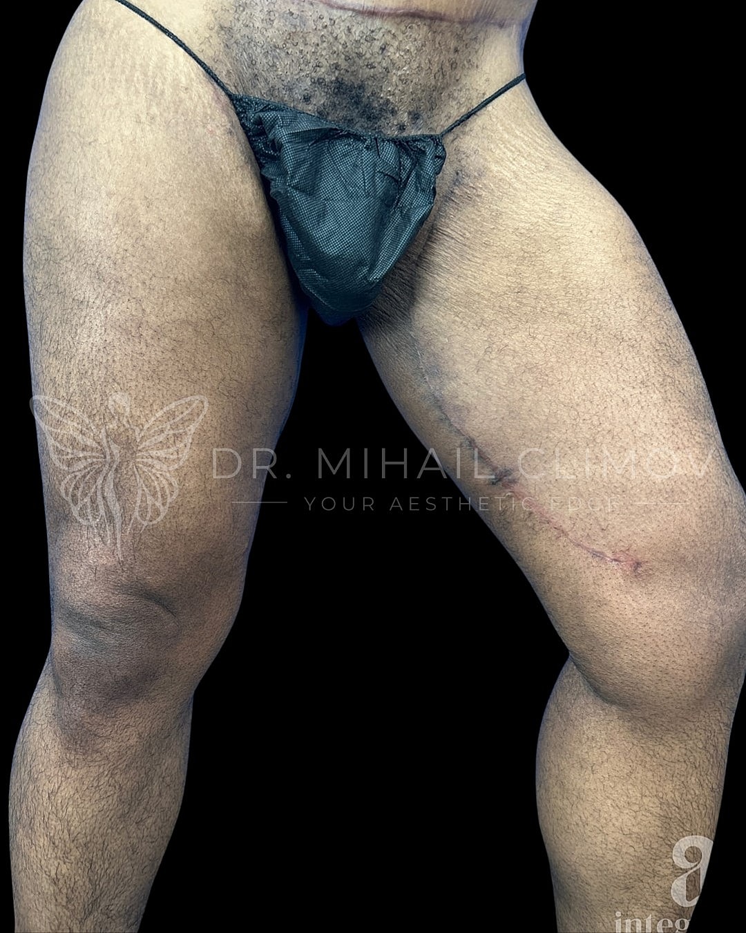 Male legs with visible scars and hair.